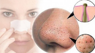 Bí quyết mới: Kem đánh răng có thể trị mụn đầu đen