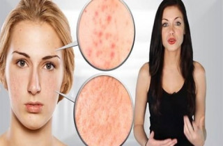 Làm thế nào để xóa mờ vết thâm và sẹo mụn?