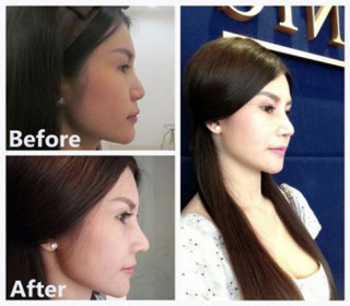 Loạt ảnh sau thẩm mỹ của phụ nữ Thái