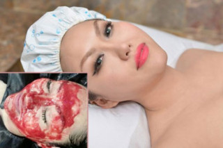 Phi Thanh Vân tiêm máu lên mặt làm đẹp