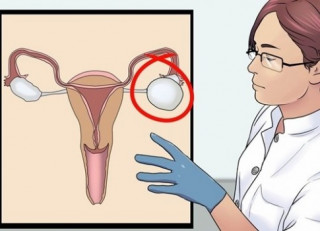 8 dấu hiệu đơn giản nhận diện u nang buồng trứng