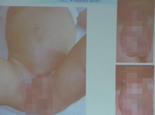 Đà Nẵng: Phẫu thuật tái tạo bộ phận sinh dục cho 7 bệnh nhi
