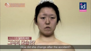 Cô gái biến dạng sau tai nạn ‘lột xác’ nhờ dao kéo