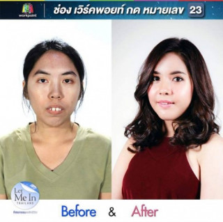 Cô gái Thái Lan răng hô ‘lột xác’ bất ngờ nhờ thẩm mỹ
