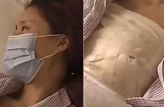 Nâng vòng 1 bị hỏng, cô gái Trung Quốc mất ngực trái