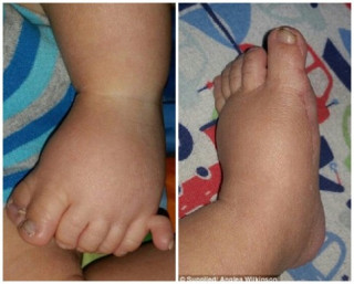 Xót xa em bé sinh ra có tới 13 ngón tay và 13 ngón chân