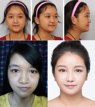 Bất ngờ với nụ cười đẹp của 2 cô gái Việt từng sứt môi