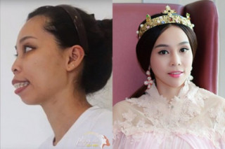 Những ca phẫu thuật thẩm mỹ bạc tỷ của ‘Phép màu sắc đẹp’.