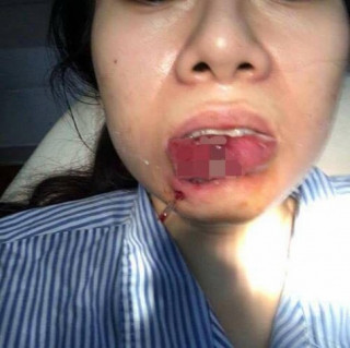 Xót xa cô gái Quảng Ninh phải cắt bỏ môi sau khi tiêm chất làm đầy