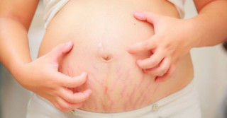 Giải pháp hữu hiệu điều trị rạn da mang thai và sau khi sinh