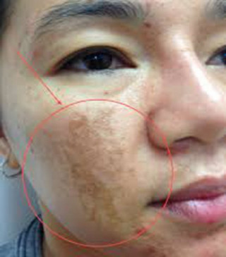 Cách trị tàn nhang, nám và “thổi bay” sạm da không hề khó