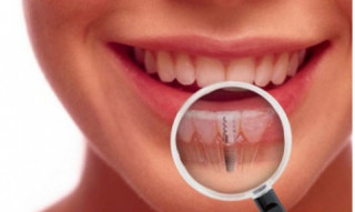 Những yếu tố nào ảnh hưởng đến kết quả trồng răng Implant