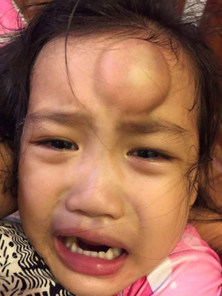 Con gái Vân Ốc sưng đầu, con Hồng Nhung từng gãy xương vì tai nạn trẻ nào cũng có thể gặp phải