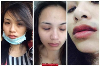 Diễm Hương công khai vết tích bị hành hung