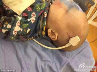 Ngã từ giường xuống đất, bé trai 2 tuổi bị phích điện cắm xiên vào não