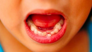 Tại sao nha sĩ khuyên cất giữ răng sữa của trẻ để khi cần có thể cứu mạng con?