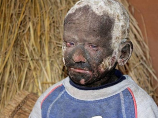 Ngỡ ngàng trước diện mạo mới “thay da đổi thịt” của cậu bé 11 tuổi mắc căn bệnh “hóa đá”