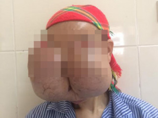 Cắt bỏ 2 khối u khổng lồ trên mặt người phụ nữ