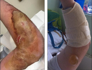 Chàng trai bị bỏng tay nghiêm trọng vì nhện độc cắn