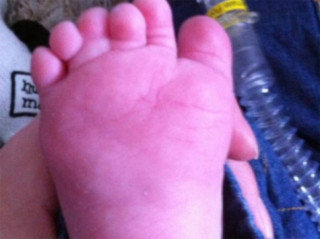 Bệnh hiếm gặp: Bé trai có 12 ngón chân, 12 ngón tay
