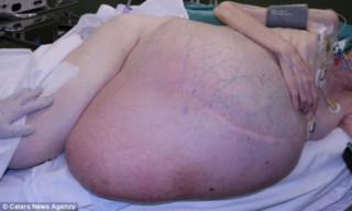 Phẫu thuật lấy khối u hơn 38 kg