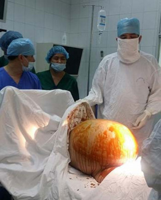Con dâu mang khối u khủng 23kg: Mẹ chồng hụt hẫng
