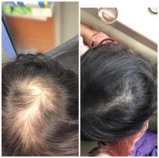 Spa Thu Linh: Dịch vụ cấy tóc công nghệ cao, không xâm lấn