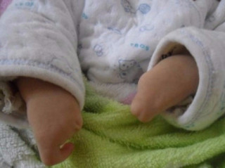 Xót thương bé sơ sinh chào đời với hình dạng bàn tay, bàn chân giống như càng cua