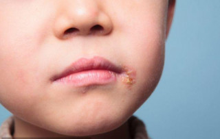 Bé trai 5 tuổi ra đi vì nổi mụn rộp quanh miệng, BS chỉ ra “hung thủ” thực sự từ thói quen của người lớn