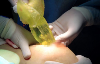Nữ bệnh nhân bị vỡ túi ngực 60 triệu phải phẫu thuật khẩn cấp vì silicon chảy tràn