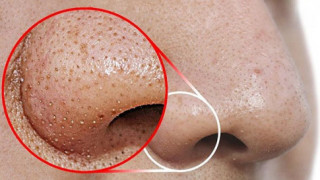 Các cách an toàn, hiệu quả để loại bỏ mụn đầu đen vùng mũi