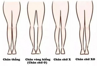 Mẹo chọn đồ khắc phục dáng chân chữ bát, chân vòng kiềng