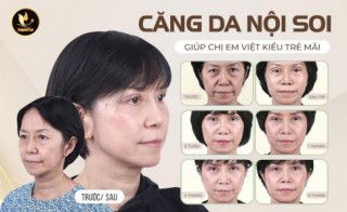 Căng da mặt nội soi: Xu thế mới giúp chị em Việt Kiều trẻ mãi