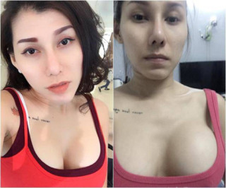 Câu trả lời bất ngờ từ chuyên gia: “Túi ngực có thế bị rách, thủng,... chứ không thể bị NỔ!”
