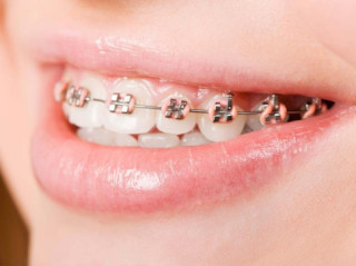 Chị em “tuổi băm” mà vẫn muốn niềng răng hãy đọc ngay bài viết này!