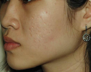 Có những cách trị sẹo rỗ này, mặt lỗ chỗ đến mấy cũng được san bằng chỉ sau 2 tuần