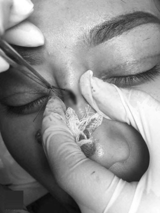 Dân mạng xôn xao trước ca “thảm họa” thủng da đầu mũi, lộ chỉ trắng ngay khi phẫu thuật