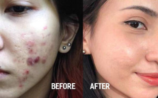 Hành trình trị mụn kiên trì 11 năm của cô gái gốc Việt gây chấn động báo nước ngoài
