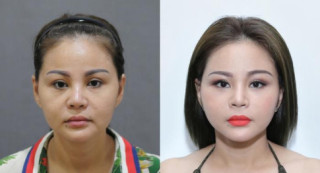 Kỷ lục những lần dao kéo nghe qua thấy thót tim của các “nữ hoàng thẩm mỹ Việt”