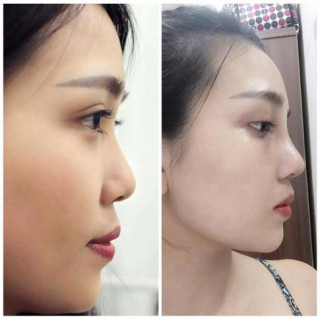 Nâng mũi Hàn Quốc và những kiến thức quan trọng bạn BUỘC phải biết!