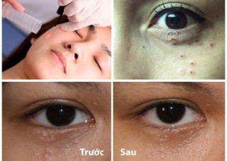 Nếu gặp phải những loại mụn này, đừng dại động vào mà hãy để chúng “tự sinh tự diệt”
