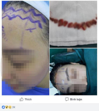 Sửa mũi cắt môi đã là gì, chị em bây giờ còn rủ nhau đi cắt da đầu để...