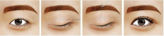Cắt mí mắt và những kiến thức cần biết để tránh hậu quả khôn lường