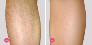 Hè rồi, đi biển chẳng dám mặc bikini vì chân nhiều lông, hãy áp dụng ngay 2 công thức này