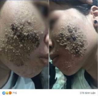Khuôn mặt nổi từng mảng vì mê làm đẹp nhưng không rõ nguồn gốc, cô gái khiến CĐM xôn xao