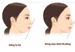 Ngỡ ngàng trước sự lột xác vi diệu nhờ niềng răng, dung mạo thay đổi 180 độ