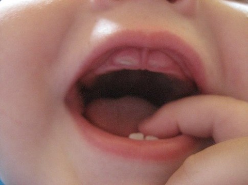 Làm gì khi bé chậm mọc răng?