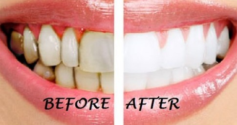 10 cách làm trắng răng tự nhiên