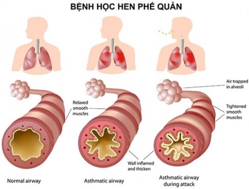 Bệnh hen phế quản: 5 ngộ nhận nguy hiểm