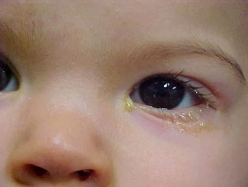 3 dấu hiệu nguy hiểm với mắt của bé